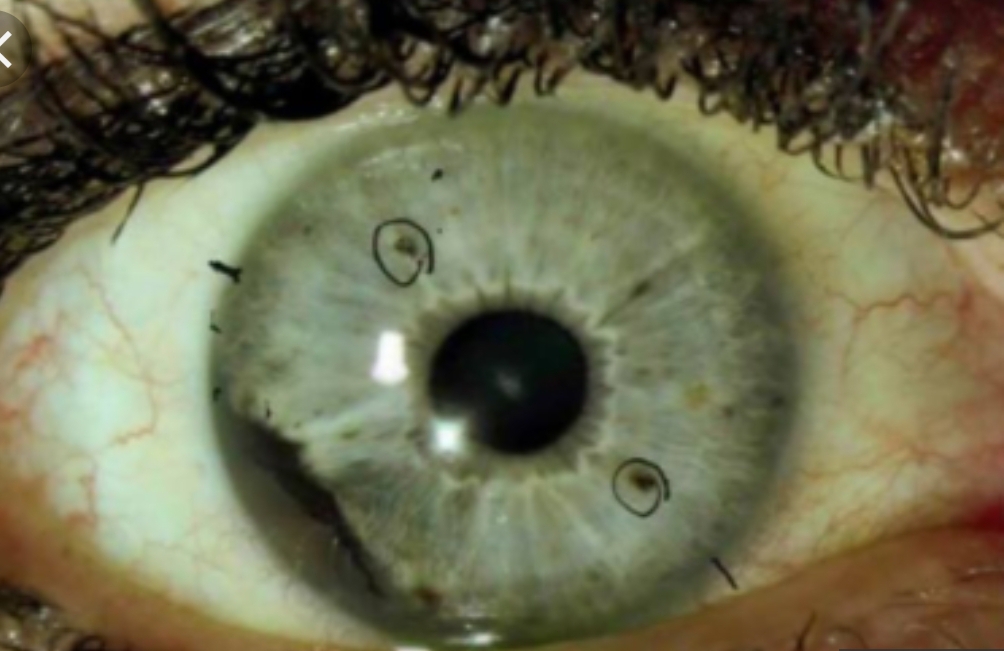 Auburn University to fund ocular melanoma research project